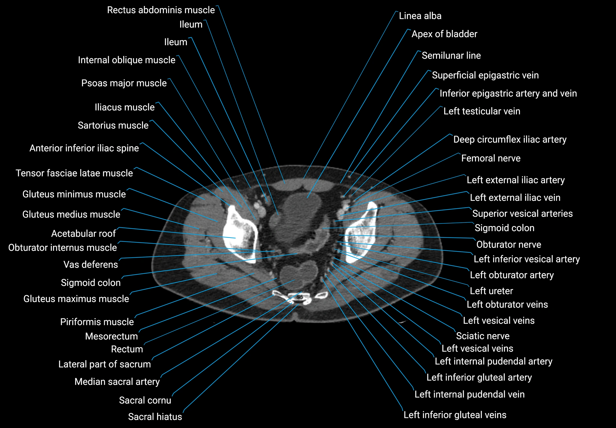 CT male pelvis axial cross sectional anatomy labelled radiology image -00175.webp